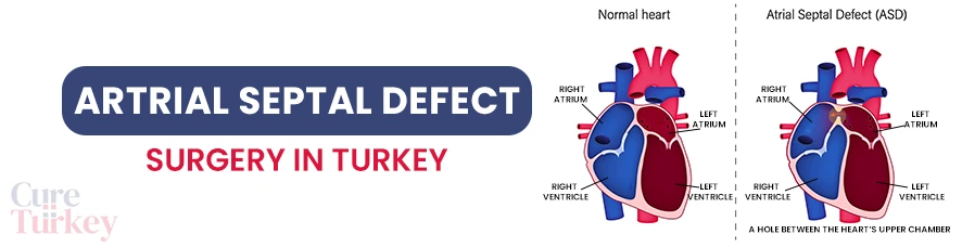 Artrial Septal Defect